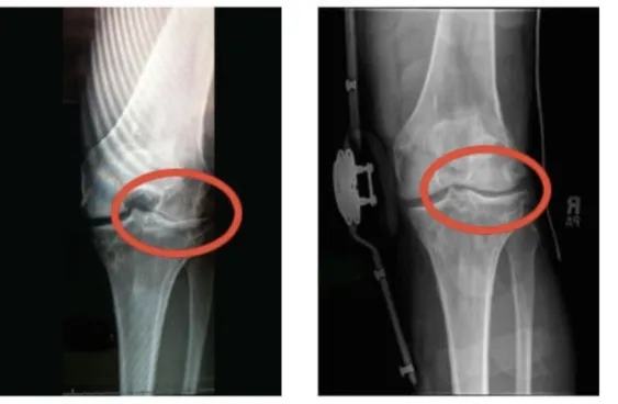 knee xray image